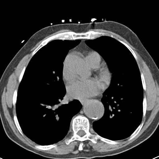 Aortic intramural hematoma (Radiopaedia 31139-31838 Axial non-contrast 33).jpg