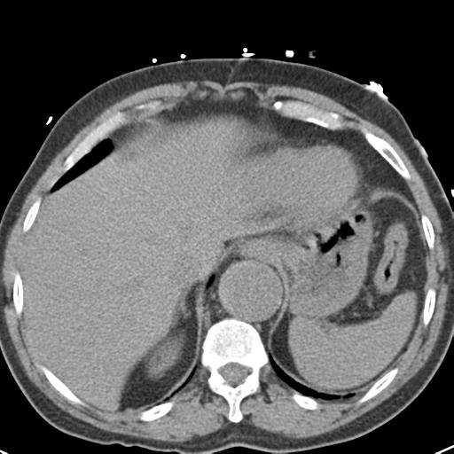 File:Aortic intramural hematoma (Radiopaedia 31139-31838 Axial non-contrast 46).jpg