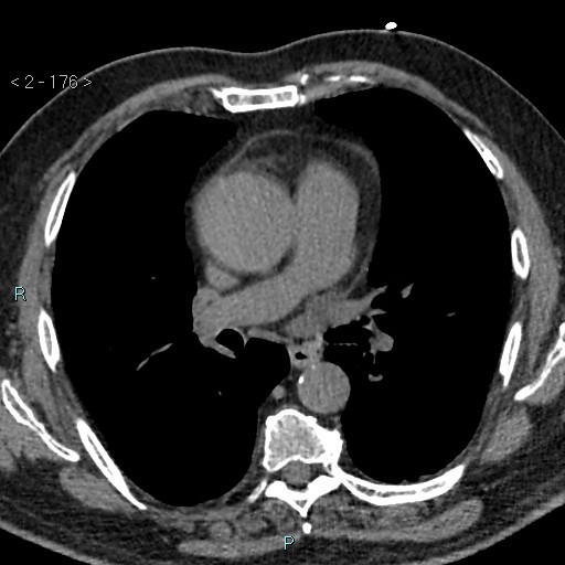 Aortic intramural hematoma (Radiopaedia 48463-53380 Axial non-contrast 78).jpg