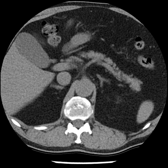 Aortic intramural hematoma (type B) (Radiopaedia 79323-92387 Axial non-contrast 58).jpg