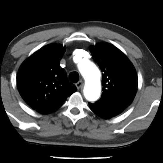 Aortic intramural hematoma (type B) (Radiopaedia 79323-92387 B 12).jpg