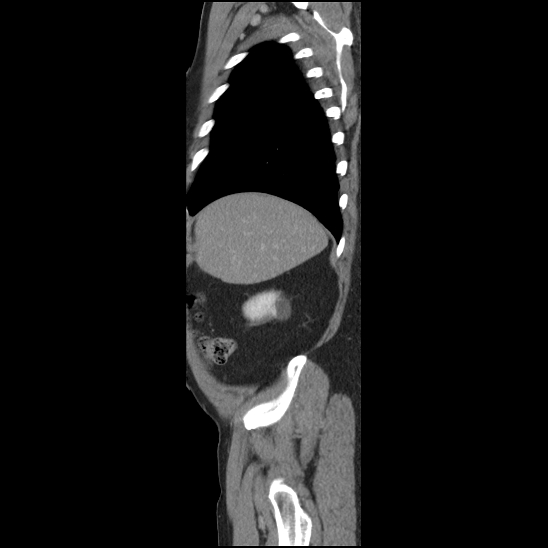 Aortic intramural hematoma (type B) (Radiopaedia 79323-92387 Sagittal C+ delayed 2).jpg