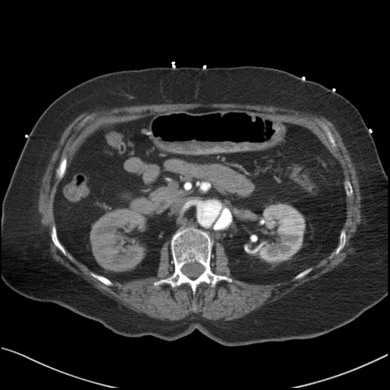 Aortic intramural hematoma with dissection and intramural blood pool (Radiopaedia 77373-89491 B 125).jpg