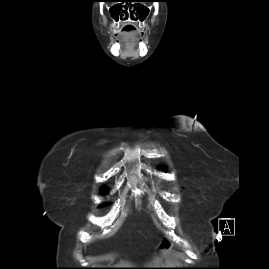 File:Aortic intramural hematoma with dissection and intramural blood pool (Radiopaedia 77373-89491 C 1).jpg