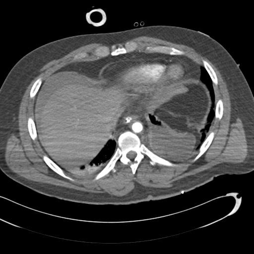 Aortic transection, diaphragmatic rupture and hemoperitoneum in a complex multitrauma patient (Radiopaedia 31701-32622 A 66).jpg