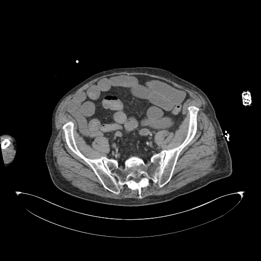 Aortoduodenal fistula (Radiopaedia 75286-86415 Axial non-contrast 55).jpg