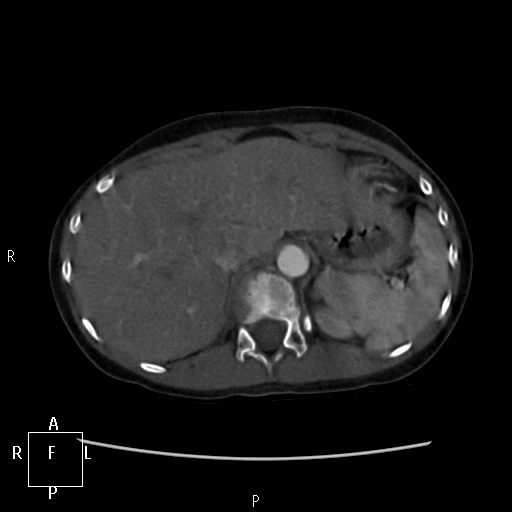 File:Aortopulmonary septal defect (Radiopaedia 41990-45013 Axial C+ CTPA 2).jpg