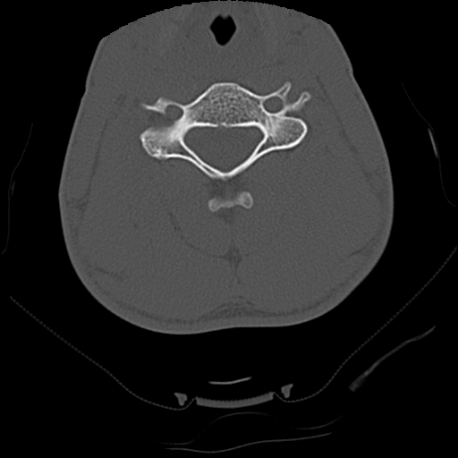 Apical pneumothorax on cervical spine CT (Radiopaedia 45343-49368 Axial bone window 51).jpg