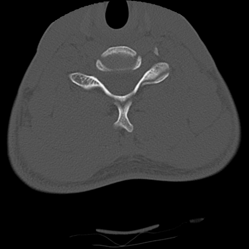 File:Apical pneumothorax on cervical spine CT (Radiopaedia 45343-49368 Axial bone window 64).jpg