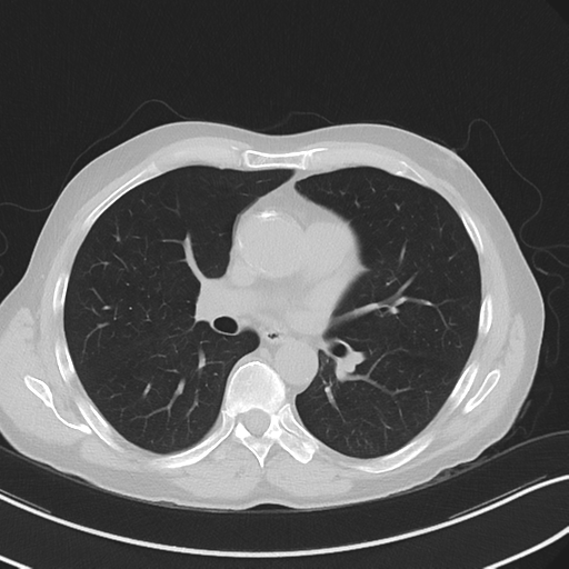 Apical pulmonary metastasis (Radiopaedia 46338-50754 Axial non-contrast 33).png