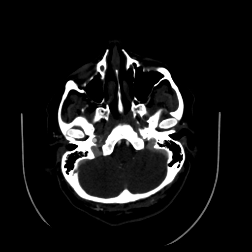 Aplasia of the internal carotid artery (Radiopaedia 61082-68960 A 14).jpg