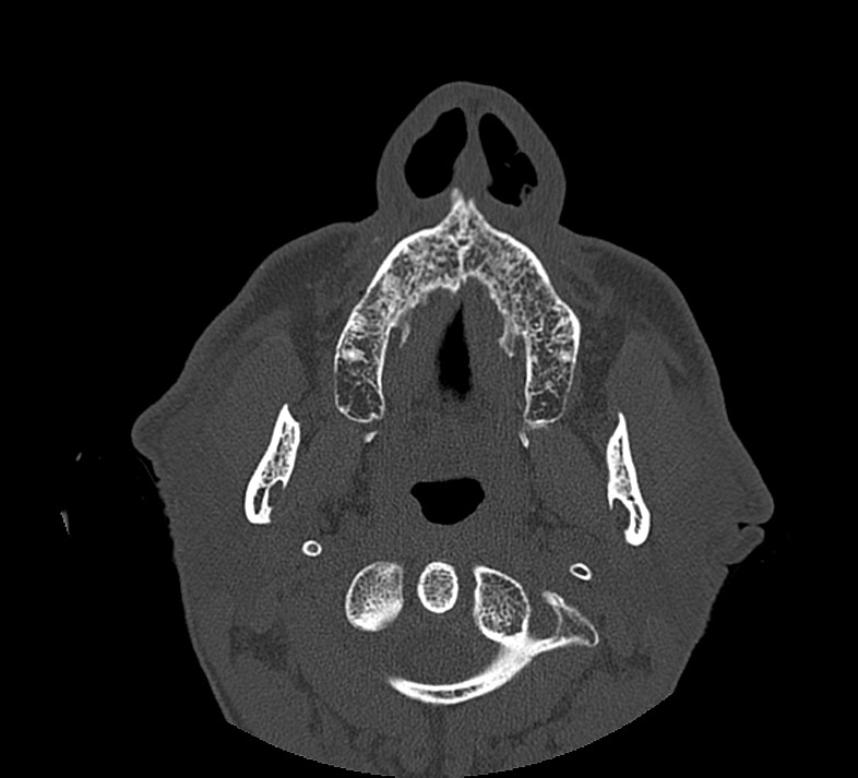 Aplastic maxillary sinuses (Radiopaedia 60030-67561 Axial non-contrast 9).jpg
