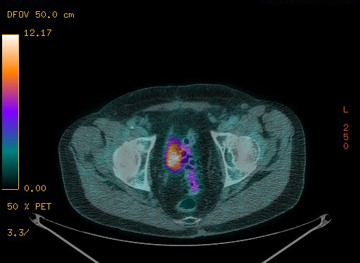 Appendiceal adenocarcinoma complicated by retroperitoneal abscess (Radiopaedia 58007-65041 Axial PET-CT 182).jpg