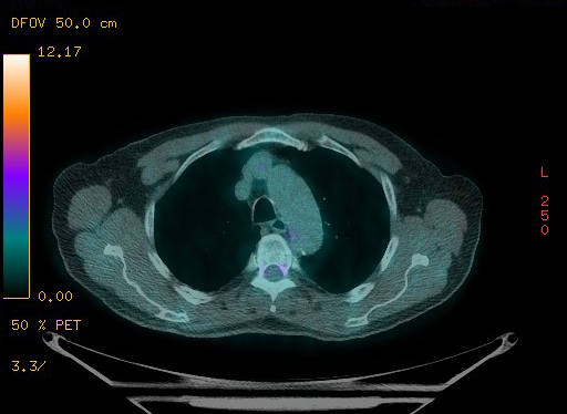 Appendiceal adenocarcinoma complicated by retroperitoneal abscess (Radiopaedia 58007-65041 Axial PET-CT 49).jpg