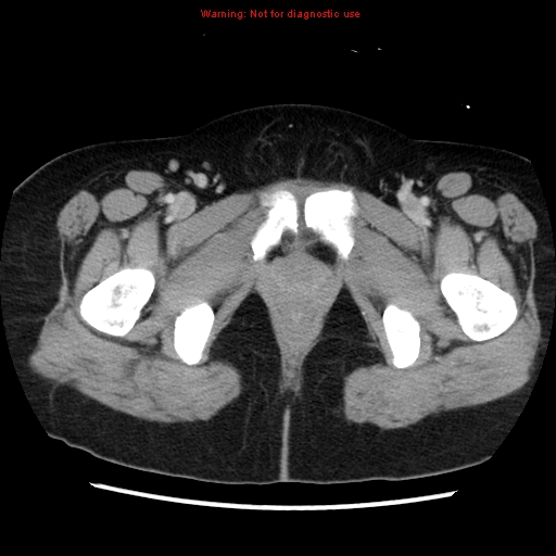 Appendiceal mucinous cystadenoma (Radiopaedia 8263-9111 Axial liver window 83).jpg