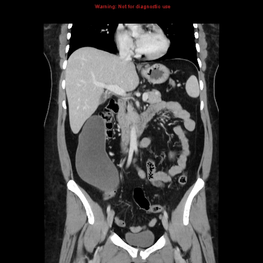 Appendiceal mucinous cystadenoma (Radiopaedia 8263-9111 B 34).jpg