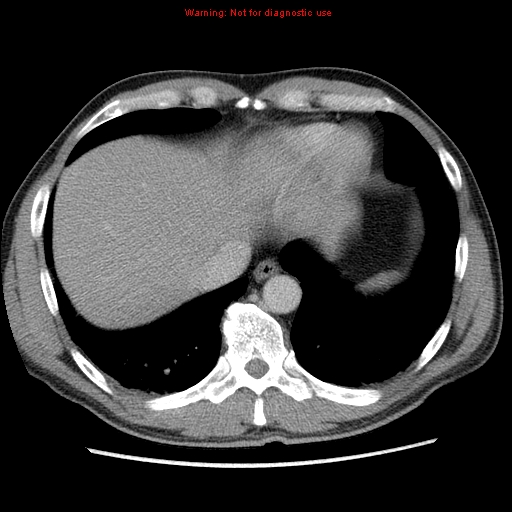 Appendicitis and renal cell carcinoma (Radiopaedia 17063-16760 A 5).jpg