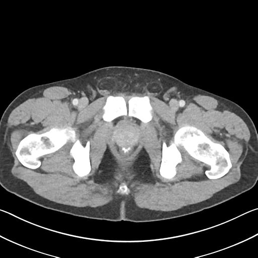 Appendicitis with cecal bar sign (Radiopaedia 31878-32830 B 82).jpg
