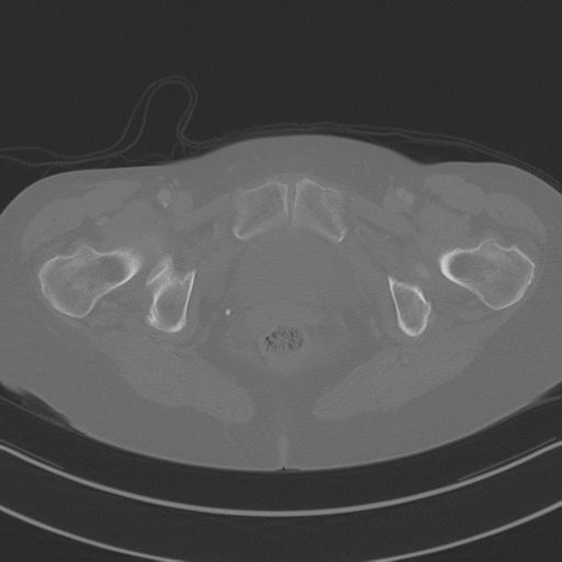 April fools' 2019- calcified peritoneal arachnoidosis (Radiopaedia 67273-76636 Axial bone window 59).png