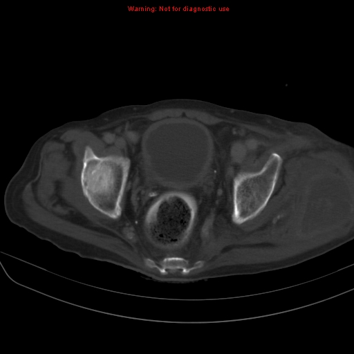 File:Arachnoiditis ossificans (Radiopaedia 51394-57136 Axial bone window 40).jpg