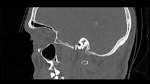 Arcuate foramen (Radiopaedia 89833-106944 Sagittal bone window 2).jpg