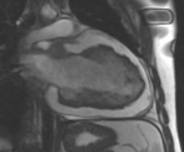 Arrhythmogenic right ventricular cardiomyopathy (Radiopaedia 69431-79307 2ch cine 16).jpg