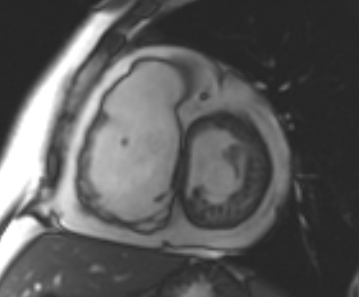 File:Arrhythmogenic right ventricular cardiomyopathy (Radiopaedia 69431-79307 Short axis cine 155).jpg