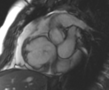File:Arrhythmogenic right ventricular cardiomyopathy (Radiopaedia 69431-79307 Short axis cine 205).jpg