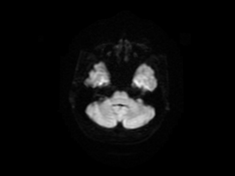 File:Artery of Percheron infarct (Radiopaedia 36897-38526 Axial DWI 3).jpg