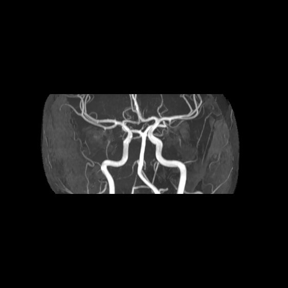 File:Artery of Percheron infarct (Radiopaedia 40966-43676 G 32).jpg