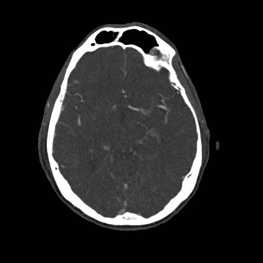 File:Artery of Percheron infarct (Radiopaedia 48088-52894 A 132).jpg
