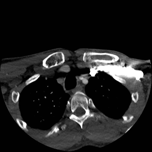 Artery of Percheron infarct (Radiopaedia 48088-52894 A 20).jpg