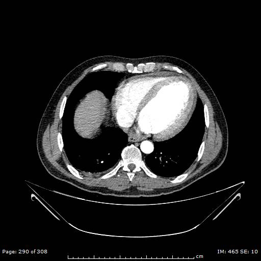 Ascending aortic aneurysm (Radiopaedia 50086-55404 A 73).jpg