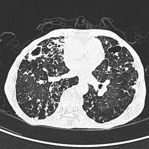 Aspergilloma- with Monod sign (Radiopaedia 44737-48532 Axial lung window 154).jpg