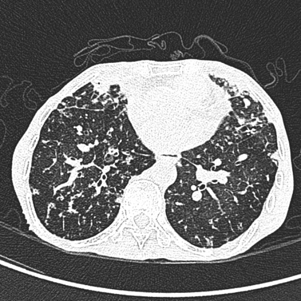 File:Aspergilloma- with Monod sign (Radiopaedia 44737-48532 Axial lung window 176).jpg