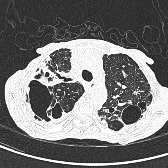File:Aspergilloma- with Monod sign (Radiopaedia 44737-48532 Axial lung window 84).jpg
