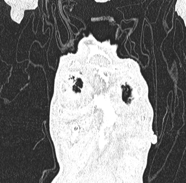 Aspergilloma- with Monod sign (Radiopaedia 44737-48532 Coronal lung window 125).jpg