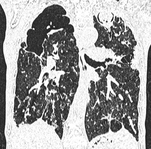 Aspergilloma- with Monod sign (Radiopaedia 44737-48532 Coronal lung window 277).jpg
