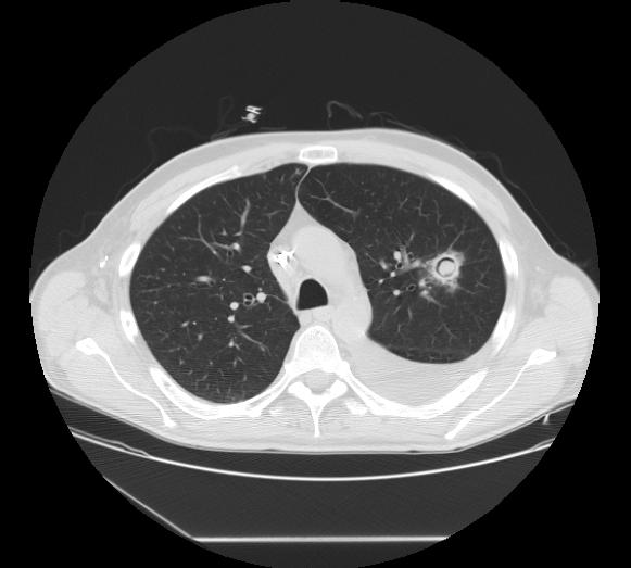 File:Aspergilloma (Radiopaedia 11216-11581 Axial lung window 1).jpg