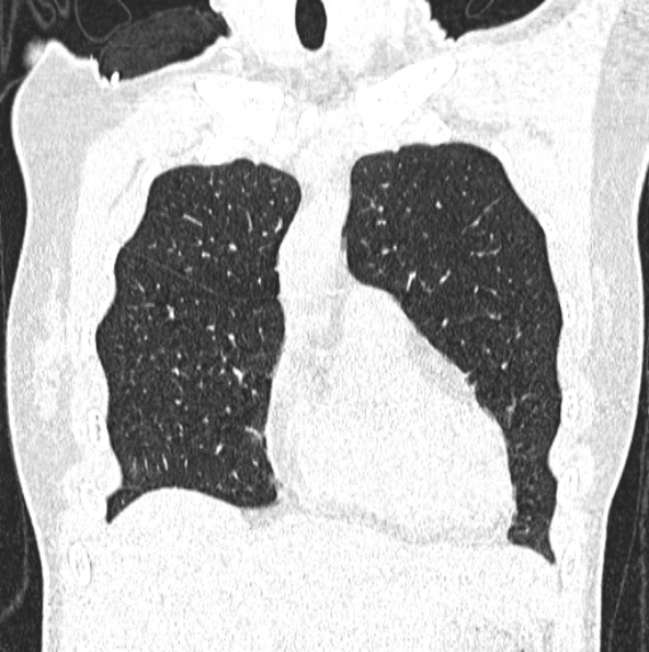 File:Aspergilloma (Radiopaedia 26223-26347 Coronal lung window 13).jpg