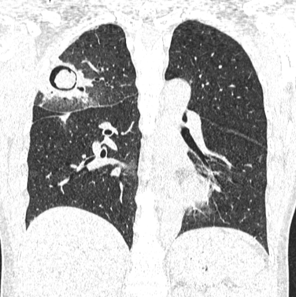 File:Aspergilloma (Radiopaedia 26223-26347 Coronal lung window 33).jpg