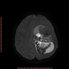 File:Astroblastoma (Radiopaedia 74287-85162 Axial DWI 76).jpg