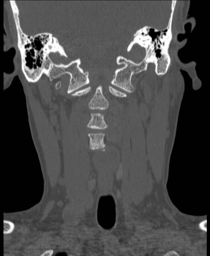 Atlanto-occipital assimilation with basilar invagination (Radiopaedia 70122-80188 Coronal bone window 70).jpg
