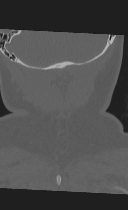 Atlanto-occipital dissociation (Radiopaedia 33848-35013 Coronal bone window 54).png