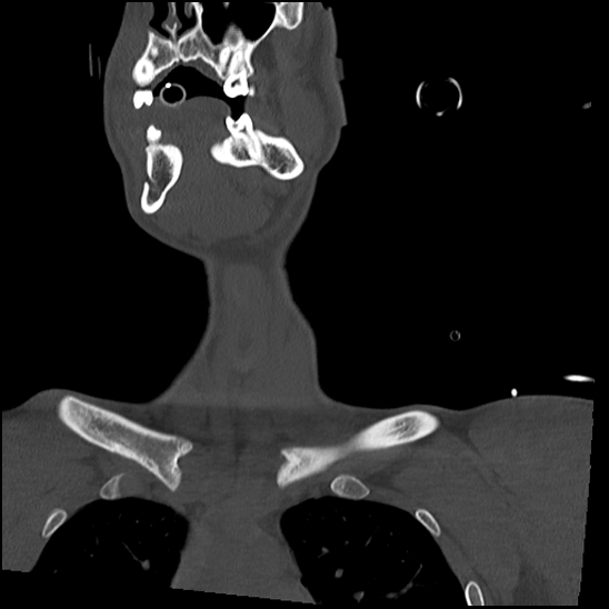 Atlanto-occipital dissociation (Traynelis type 1), C2 teardrop fracture, C6-7 facet joint dislocation (Radiopaedia 87655-104061 Coronal bone window 12).jpg