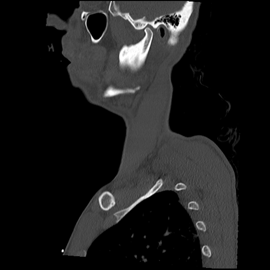 Atlanto-occipital dissociation (Traynelis type 1), C2 teardrop fracture, C6-7 facet joint dislocation (Radiopaedia 87655-104061 Sagittal bone window 7).jpg