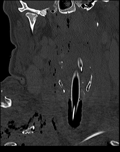 Atlanto-occipital dissociation - Traynelis type 1 (Radiopaedia 87570-103948 Coronal bone window 20).jpg