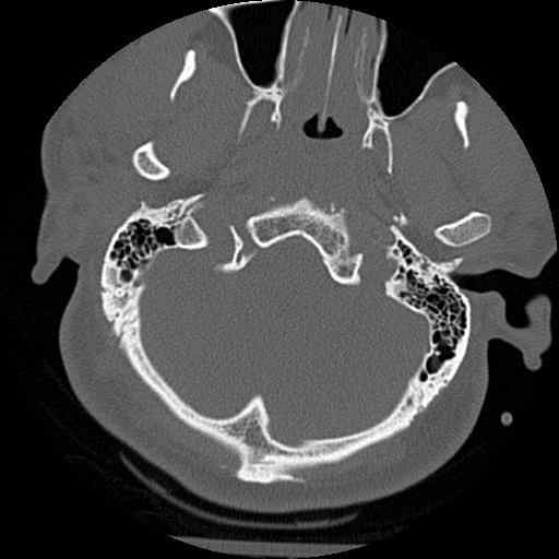 File:Atlanto-occipital dissociation injury (Radiopaedia 29274-29698 Axial bone window 3).png