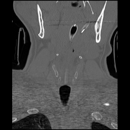 Atlanto-occipital dissociation injury (Radiopaedia 29274-29698 Coronal bone window 45).png