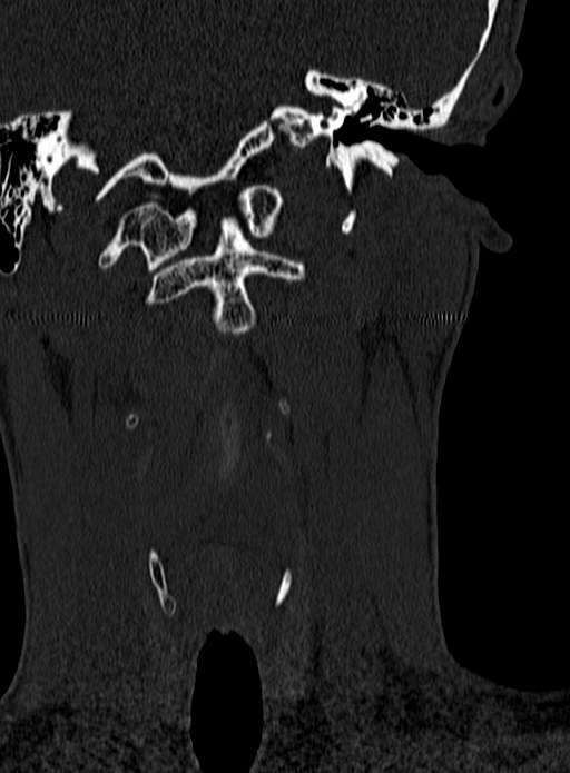 Atlantoaxial subluxation (Radiopaedia 44681-48450 Coronal bone window 10).jpg